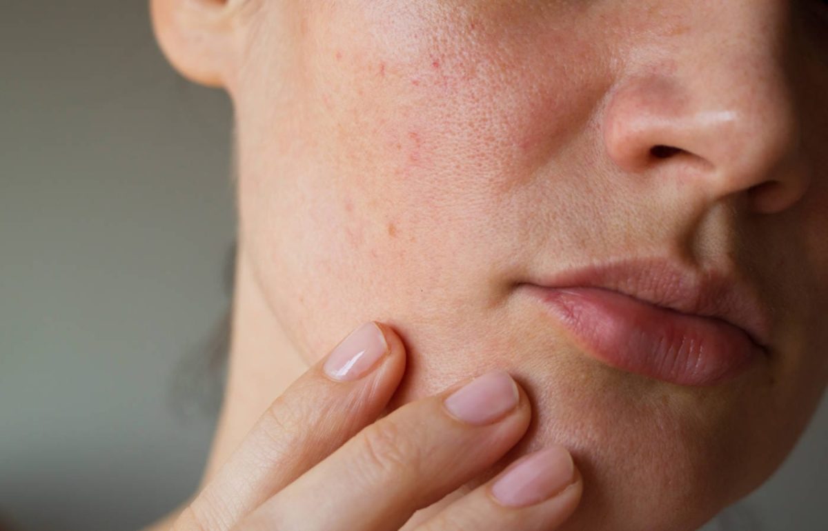 Irritated skin on a woman’s cheek